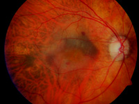 Altersabhängige Makuladegeneration