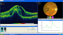 Optische-Kohärenz-Tomographie